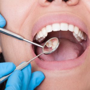 dentist looking inside female mouth with white teeth