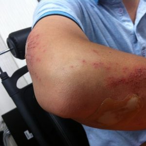 Benefits of Using an Elbow Sleeve During Injury Recovery