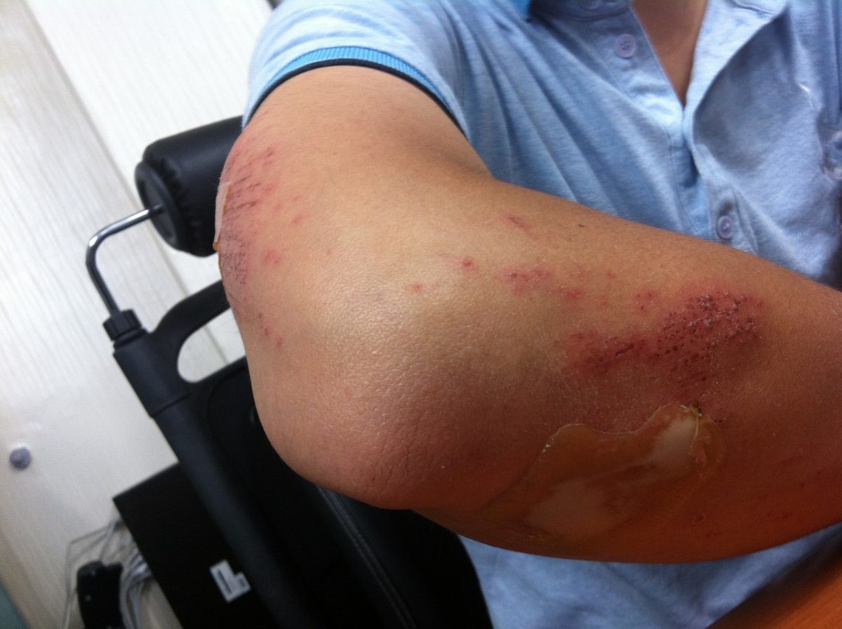 Benefits of Using an Elbow Sleeve During Injury Recovery