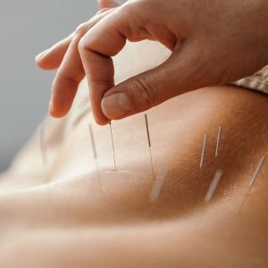 acupuncture