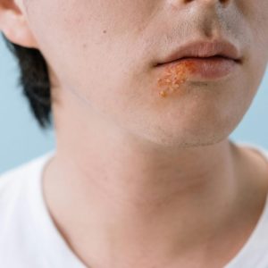 Quick Relief for Cold Sores with Online Treatment Options