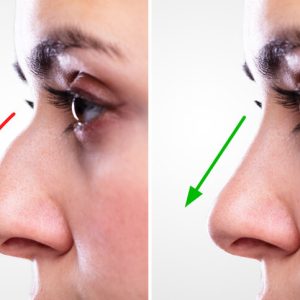 rhinoplasty nose job