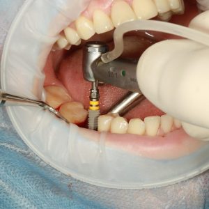 Are Dental Implants Right for You? Factors to Consider