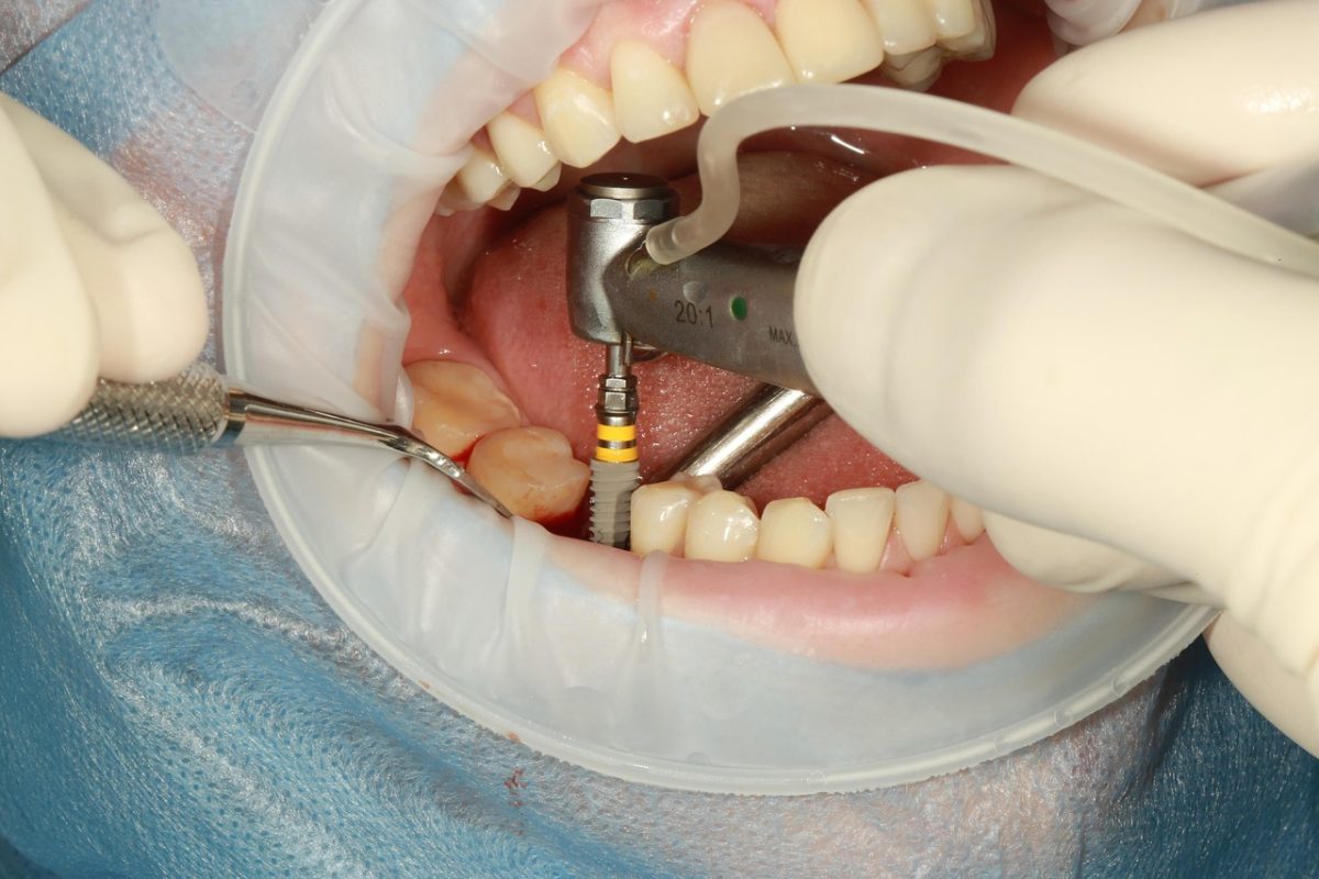 Are Dental Implants Right for You? Factors to Consider