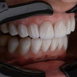 a person's teeth