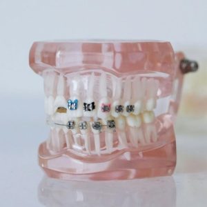 braces on a tooth display