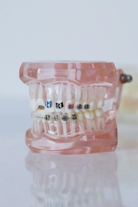 braces on a tooth display 