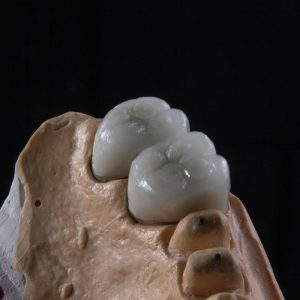 close up of a dental implant