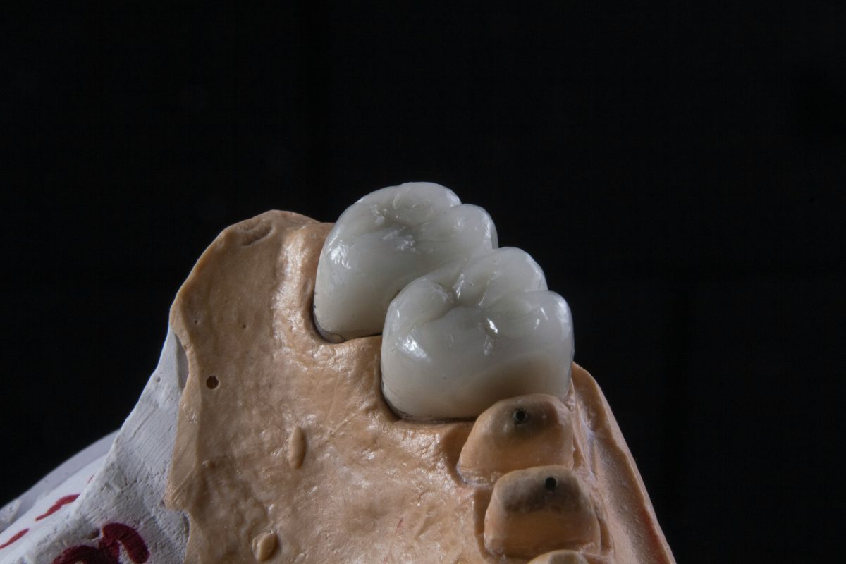 close up of a dental implant