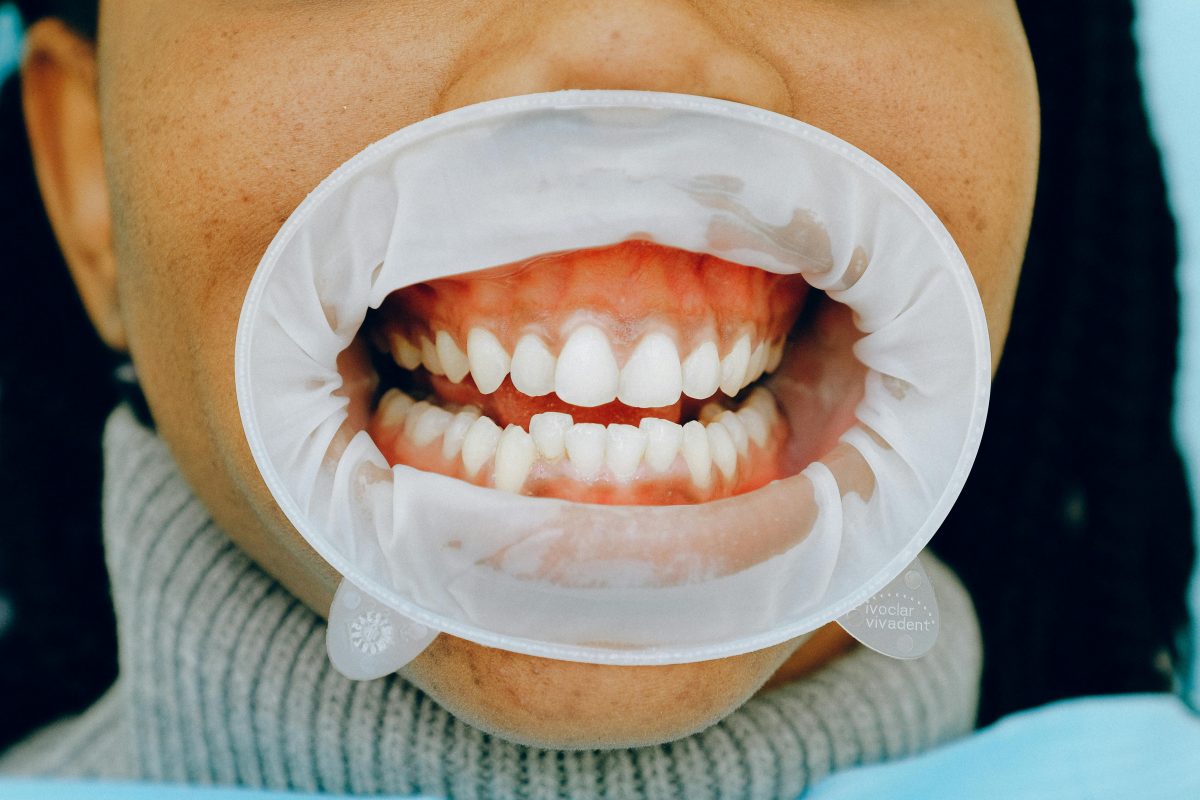 person with dental cheek retractor in mouth at dentist