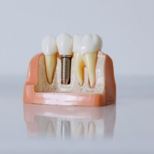 model of dental implants