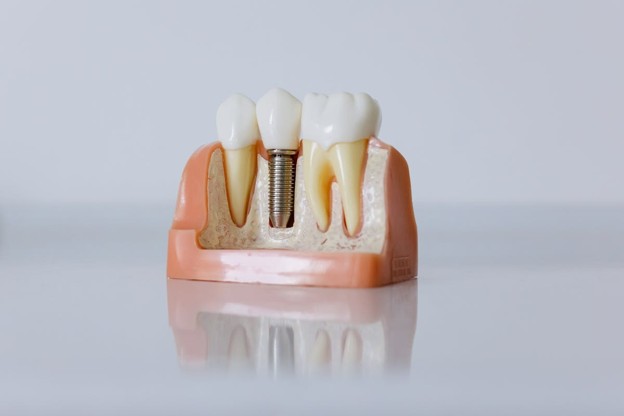 model of dental implants